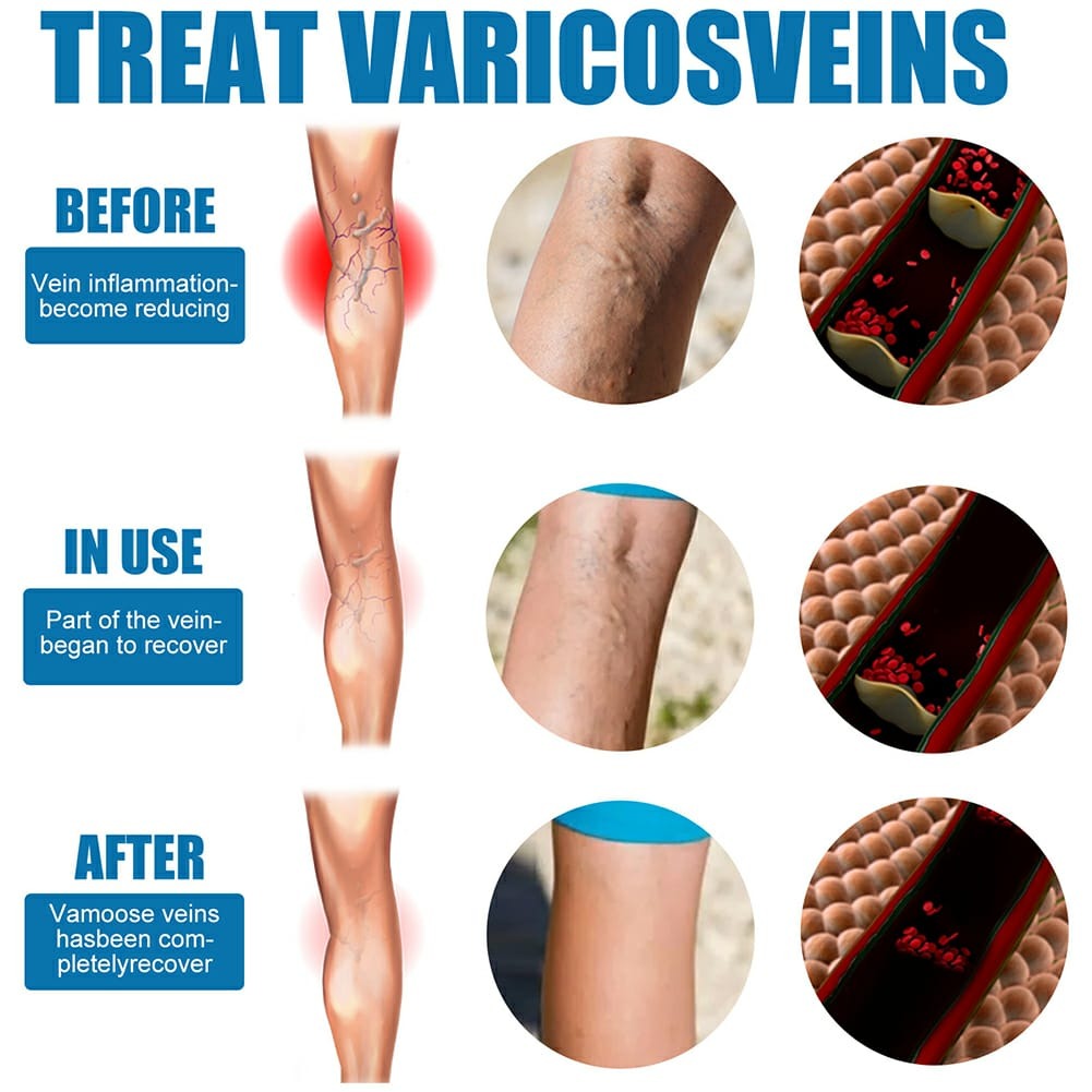 South Moon Varicose Veins Treatment Spray – 30ml Advanced Formula for Spider Veins, Leg Pain & Swelling Relief | Natural Herbal Spray for Better Circulation
